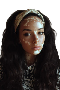 Vitiligo Girl Vinyl Car Decal Sticker – Waterproof & UV-Resistant 8" Vitiligo Girl Vinyl Car Decal Sticker – Waterproof & UV-Resistant 8"