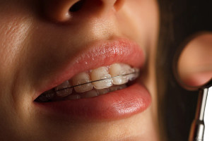 Braces Close-Up Vinyl Car Decal Sticker – Waterproof & UV-Resistant 2.986666666666667"