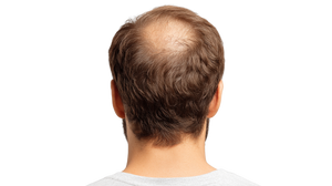 Male Hair Loss Vinyl Car Decal Sticker – Waterproof & UV-Resistant 2.72" Male Hair Loss Vinyl Car Decal Sticker – Waterproof & UV-Resistant 2.72"