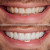 Veneers Transformation Vinyl Car Decal Sticker – Waterproof & UV-Resistant 6.826666666666667"