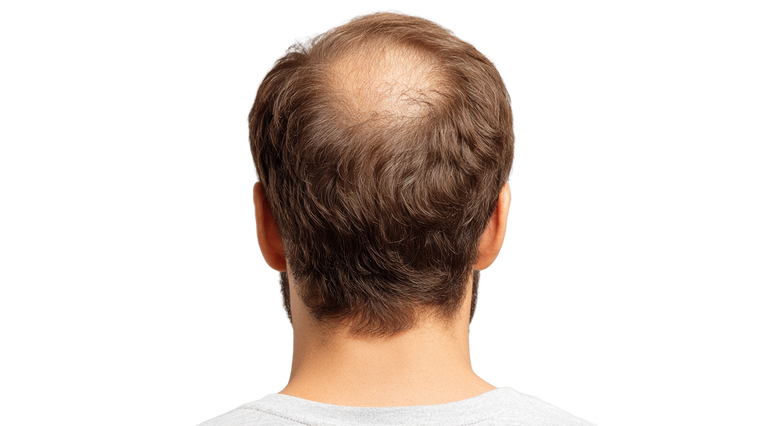 Male Hair Loss Vinyl Car Decal Sticker – Waterproof & UV-Resistant 2.72"