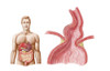 Medical ilustration of a hiatal hernia in the upper part of the stomach into the thorax Poster Print - Item # VARPSTSTK700931H