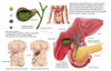 Medical ilustration showing gallstones in the gallbladder and the surgical removal of the gallbladder, known as cholecystectomy Poster Print - Item # VARPSTSTK700928H