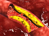 Microscopic view of fat plaque inside the artery Poster Print - Item # VARPSTSTK700479H