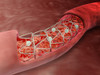 Microscopic view of an artery cross-section with blood flow and stent deployment Poster Print - Item # VARPSTSTK700302H
