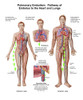 Pulmonary embolism, pathway of embolus to the heart and lungs Poster Print - Item # VARPSTSTK700829H