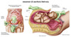 Illustration showing Caesarean delivery of fetus Poster Print - Item # VARPSTSTK700946H