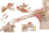 Medical illustration detailing thoracic outlet syndrome Poster Print - Item # VARPSTSTK700939H