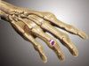 Conceptual image of rheumatoid arthritis in the human hand. RA is a chronic inflammatory disorder that typically affects the small joints in your hands and feet. Poster Print - Item # VARPSTSTK701011H