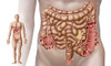 Illustration of diverticulitis in the descending colon region of the human intestine. Diverticulitis is a common digestive desease of the intestines. Poster Print - Item # VARPSTSTK700921H