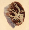 Pulmonary Clot, Illustration, 1844 Poster Print by Science Source