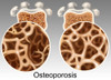 Osteoporotic & Normal Bone Poster Print by Gwen Shockey/Science Source - Item # VARSCIBY3826