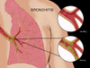 Bronchitis Poster Print by Monica Schroeder/Science Source