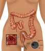 Colonoscopy Poster Print by Gwen Shockey/Science Source - Item # VARSCIBW4652