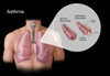 Asthma and Bronchioles Poster Print by Spencer Sutton/Science Source - Item # VARSCIBZ4299