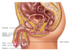 Testicular Cancer, Illustration Poster Print by Gwen Shockey/Science Source - Item # VARSCIJB6980