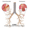 Chronic Obstructive Pulmonary Disease Poster Print by Monica Schroeder/Science Source - Item # VARSCIBV8593
