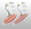 Normal Nerve and ALS Nerve Poster Print by Spencer Sutton/Science Source - Item # VARSCIJB9110