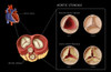 Aortic Valves, Normal & Stenosis, Illustration Poster Print by Monica Schroeder/Science Source - Item # VARSCIJB5286