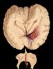 Unusual Cerebral Hemorrhage, Illustration, 1885 Poster Print by Science Source - Item # VARSCIJA1789