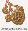 Alveoli with Emphysema Poster Print by Gwen Shockey/Science Source - Item # VARSCIBZ3637