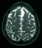 MRI Showing Arachnoid Cyst Poster Print by Science Source