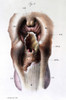 Larynx, Pathology, Illustration, 19th Century Poster Print by Science Source - Item # VARSCIJA1805