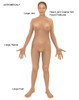 Acromegaly Poster Print by Gwen Shockey/Science Source