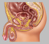 Testicular Cancer, Illustration Poster Print by Gwen Shockey/Science Source - Item # VARSCIJB6983