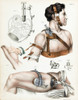 Operative Surgery, Illustration, 1846 Poster Print by Science Source - Item # VARSCIJA1808