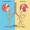 Chronic Obstructive Pulmonary Disease Poster Print by Monica Schroeder/Science Source - Item # VARSCIBV8588