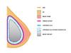 Breast Implants and Cancer Poster Print by Science Source - Item # VARSCIJB1022