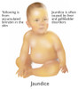 Infant with Jaundice. Poster Print by Gwen Shockey/Science Source - Item # VARSCIBY2339