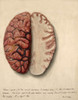 Brain, Extreme Congestion, Illustration, 1869 Poster Print by Science Source - Item # VARSCIJA1786