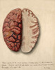 Brain, Extreme Congestion, Illustration, 1869 Poster Print by Science Source