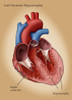 Left Ventricle Hypertrophy Poster Print by Monica Schroeder/Science Source - Item # VARSCIJB7862