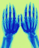 X-Ray of Two Normal Hands, 1896 Poster Print by Science Source