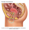 Overflow Incontinence in Female Anatomy Poster Print by Gwen Shockey/Science Source - Item # VARSCIJB6962