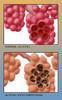 Healthy vs. Emphysematous Alveoli Poster Print by Monica Schroeder/Science Source - Item # VARSCIBZ3956