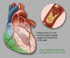 Acute Heart Failure Poster Print by Gwen Shockey/Science Source - Item # VARSCIBZ1720