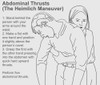 Heimlich Maneuver Poster Print by Gwen Shockey/Science Source - Item # VARSCIBY1943