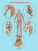 Joint Replacements, Illustration Poster Print by Gwen Shockey/Science Source - Item # VARSCIJB8445