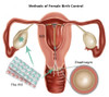 Methods of Female Birth Control Poster Print by Gwen Shockey/Science Source - Item # VARSCIBZ3668