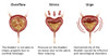 Types of Incontinence Poster Print by Gwen Shockey/Science Source - Item # VARSCIBZ3771