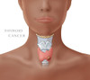 Thyroid Cancer Poster Print by Monica Schroeder/Science Source - Item # VARSCIJC2658