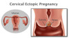 Cervical Ectopic Pregnancy Poster Print by Gwen Shockey/Science Source - Item # VARSCIBZ7423