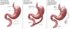 Digestive System: Normal, Gastric Band, Bypass Poster Print by Gwen Shockey/Science Source - Item # VARSCIJB2395