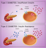 Diabetes I & II Poster Print by Monica Schroeder/Science Source - Item # VARSCIBY4064