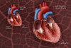 Normal Heart vs. Left Ventricle Hypertrophy Poster Print by Monica Schroeder/Science Source - Item # VARSCIJB7874