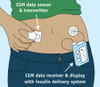 Continuous Glucose Monitor Poster Print by Science Source - Item # VARSCIJC4294
